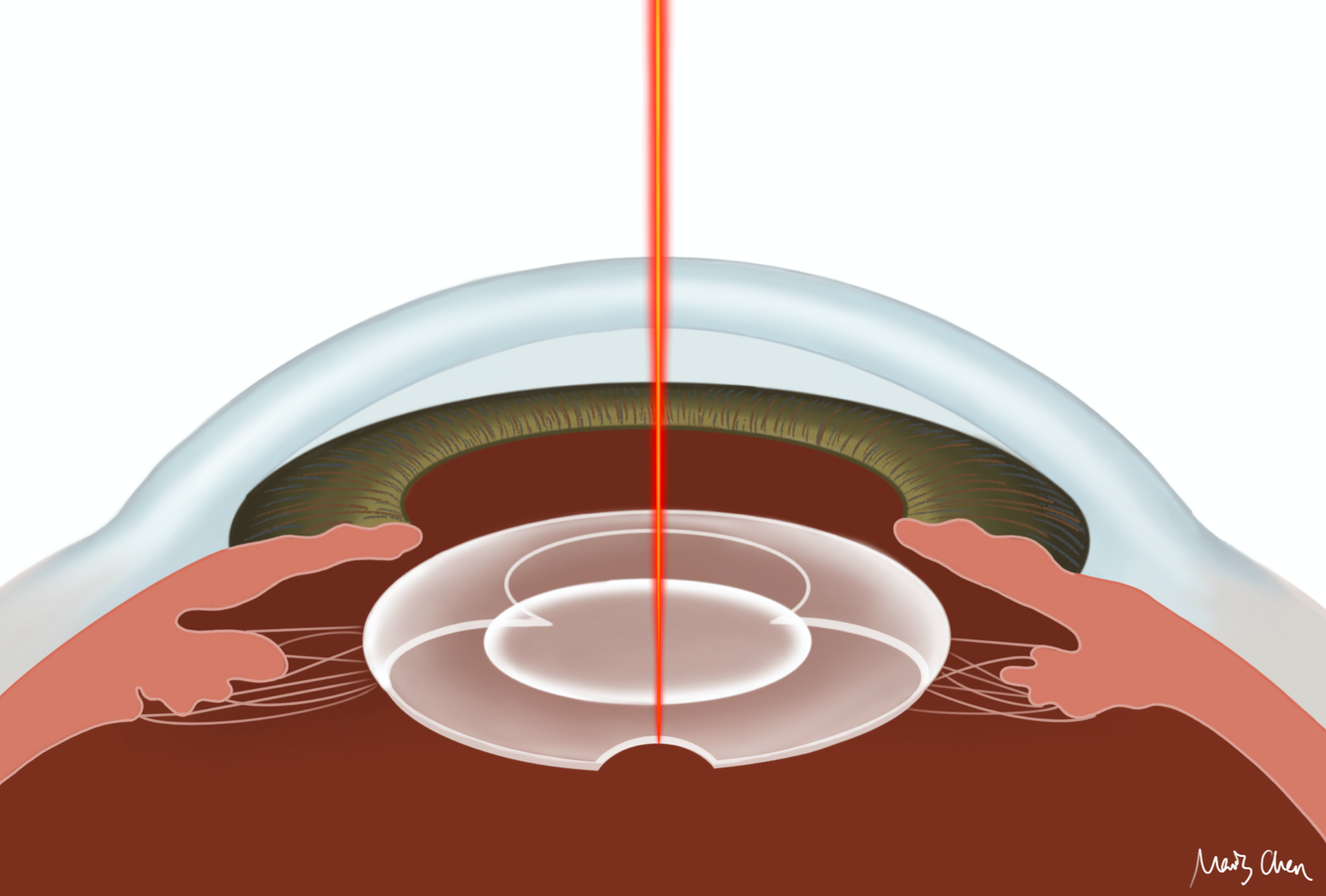 Laser Capsulotomy